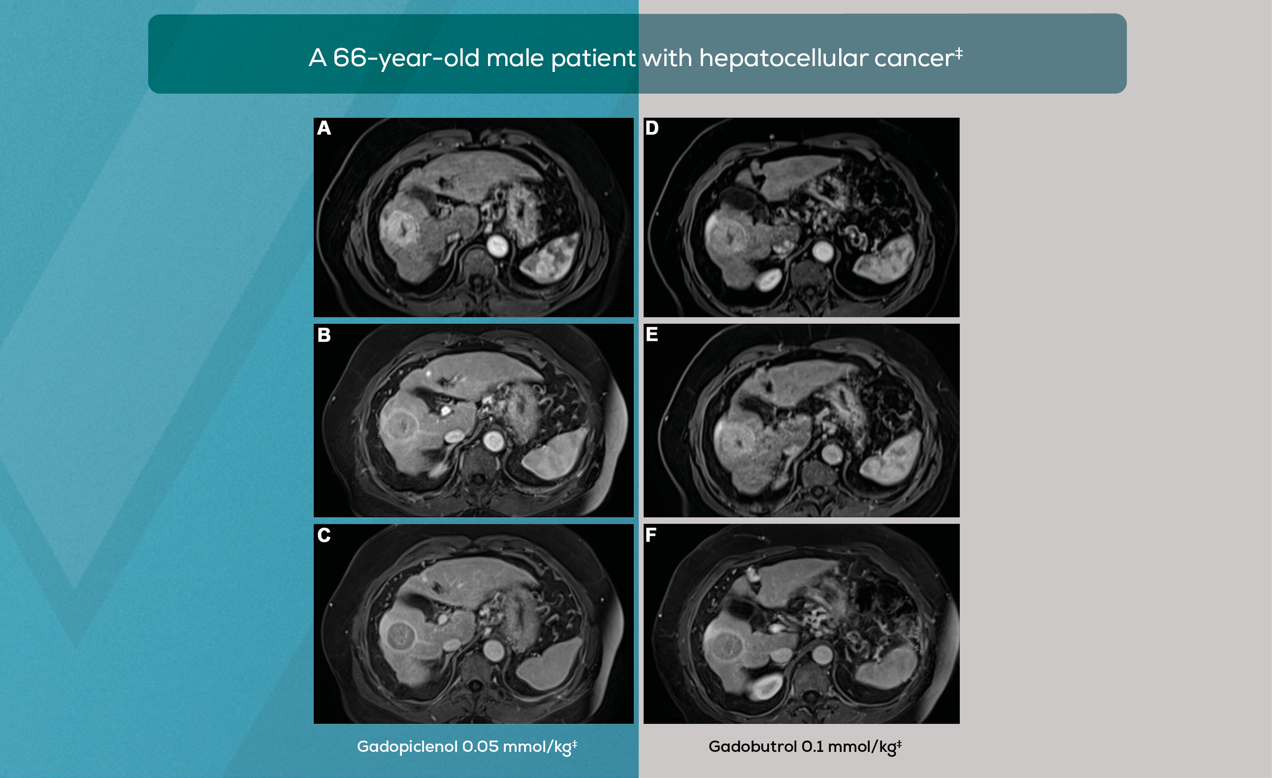 VUEWAY®- enhanced MRI Promise Study