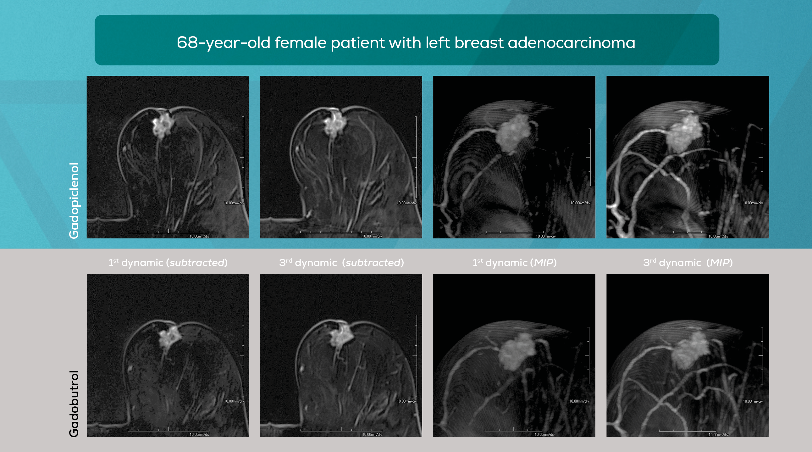 MRI of the Breast - 68-year-old female patient with left breast adenocarcinoma
