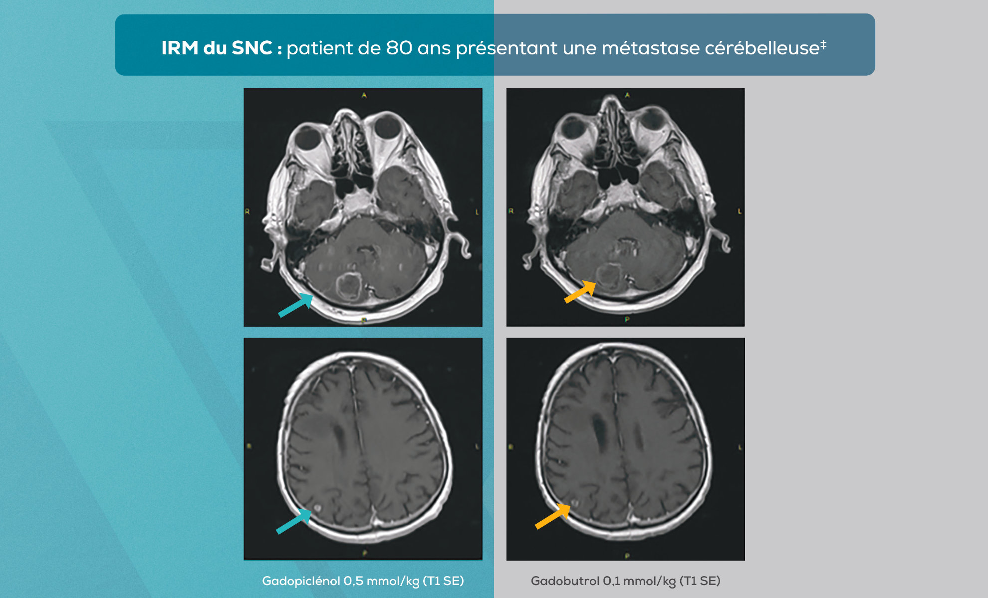 IRM du SNC : patient de 80 ans présentant une métastase cérébelleuse