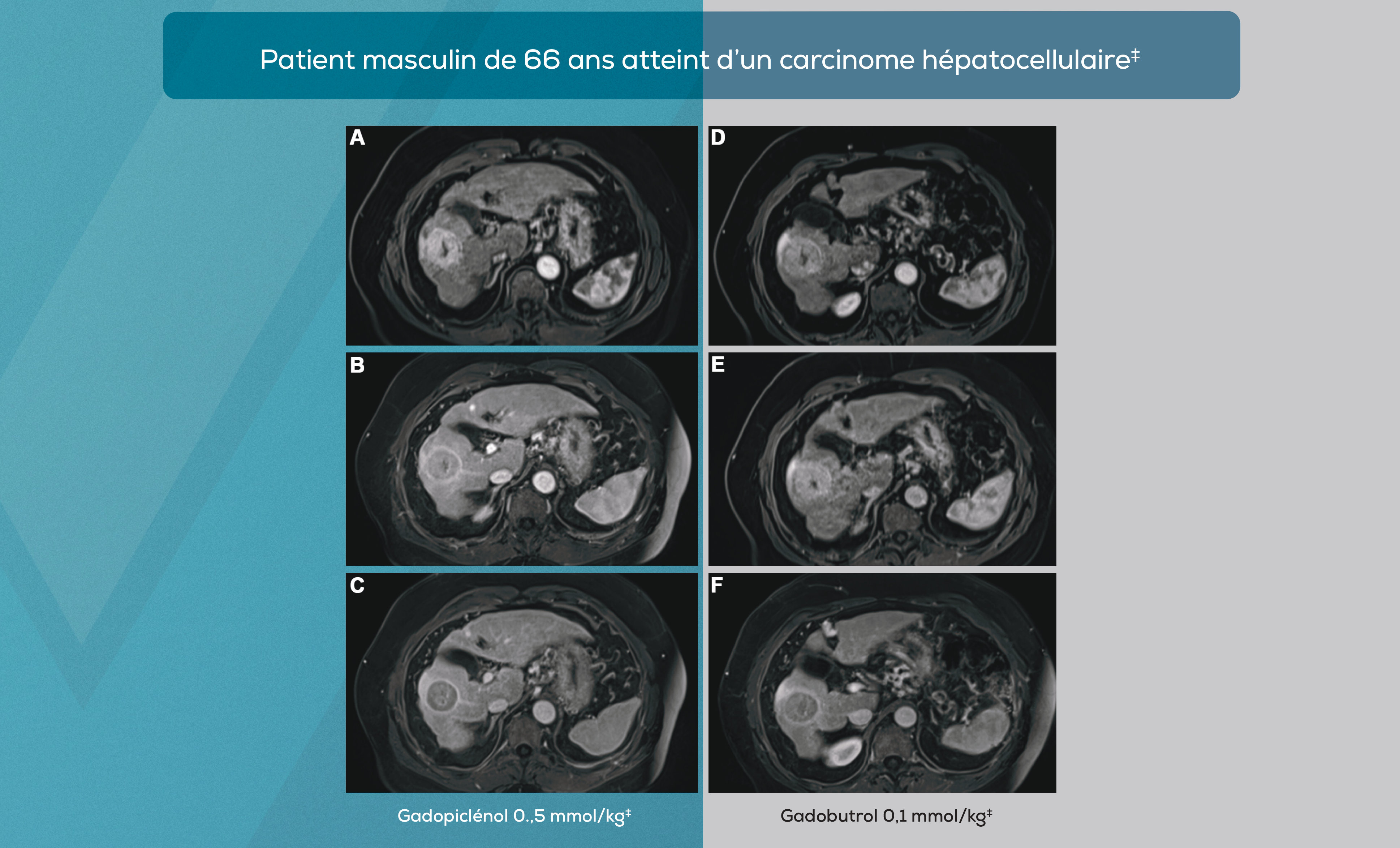 Patient masculin de 66 ans atteint d’un carcinome hépatocellulaire