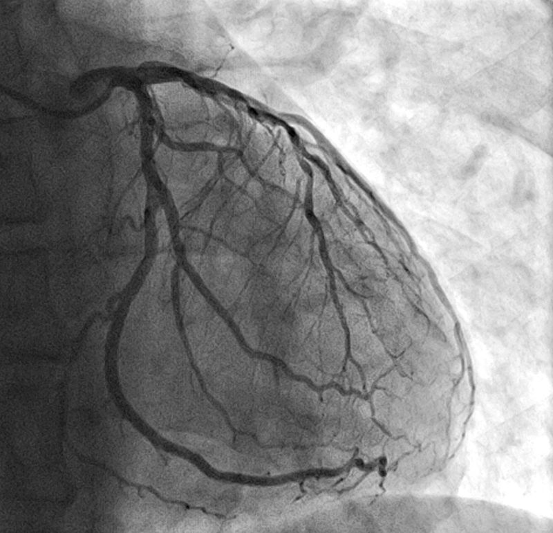 An x-ray scan of a heart. 