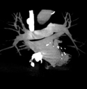 Coronal MIP from CT pulmonary angiogram