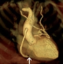 3-D volume rendered image includes the aortic root, bypass grafts, and left ventricular wall and cavity. Graft stenosis is visible near RCA touchdown.