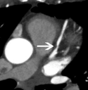 A short segment of noncalcified plaque associated with severe stenosis in the proximal LAD (arrow) is shown by multiplanar reformatted images
