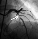 Lesion in the proximal LAD (arrow) was confirmed by conventional coronary angiography