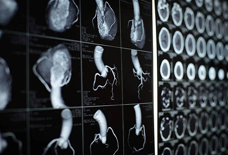 coronary artery images