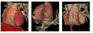 Heart shown in three different angles to demonstrate frames from the CT right ventriculagram