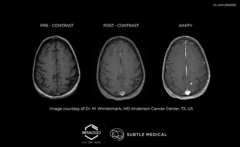 Bracco Imaging and Subtle Medical Announce CE Mark of AiMIFY™ Software for Enhanced MRI in Europe