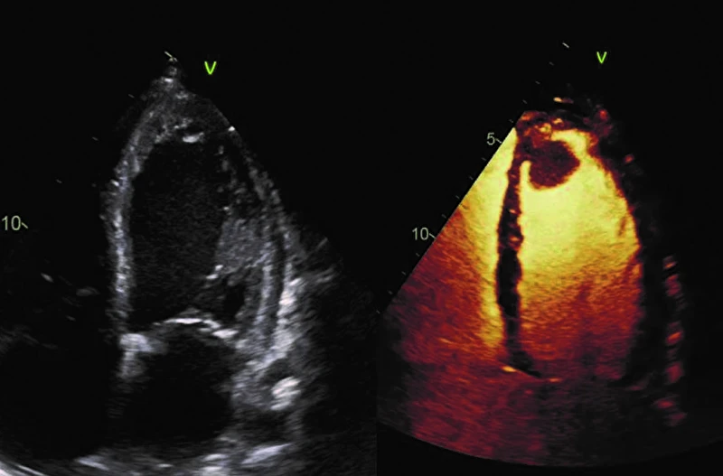 ultrasound