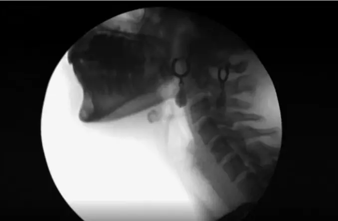 Bracco imaging: Varibar (barium sulfate) MBSS 