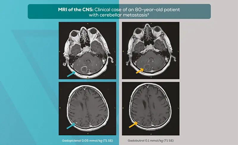 VUEWAY®- enhanced MRI: An 80-year-old patient with cerebellarmetastasis