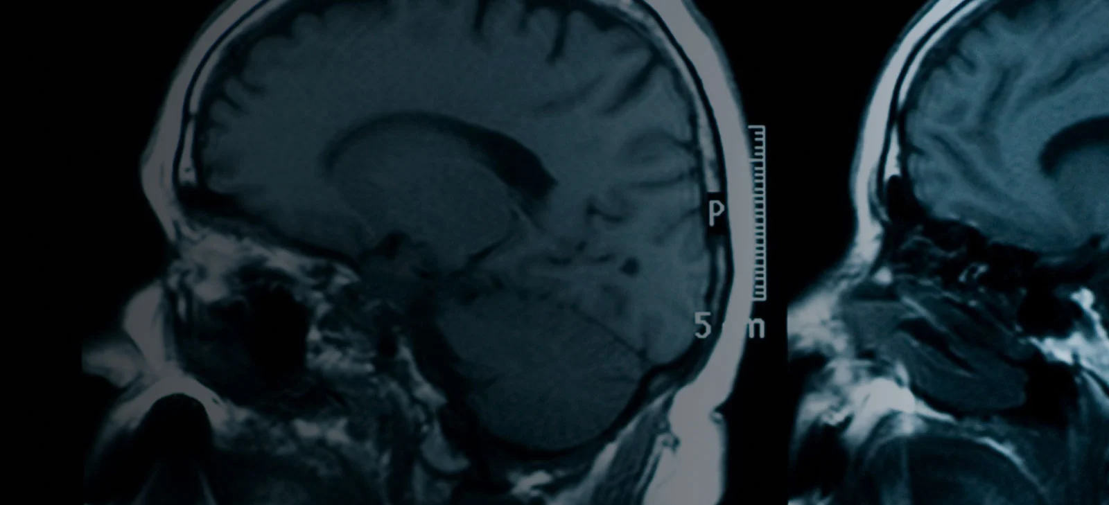 MRI